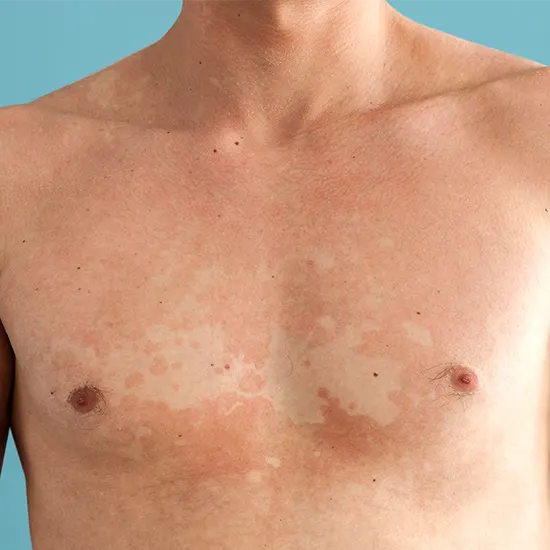 Tinea Versicolor Cases Increase In Warm And Humid Climates